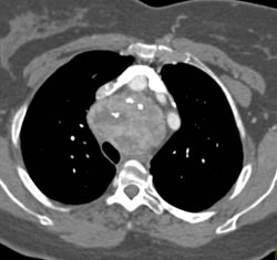 Substernal Thyroid - CTisus CT Scan