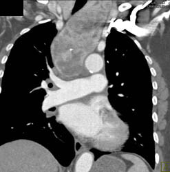 Substernal Thyroid - CTisus CT Scan