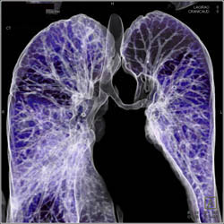 Tracheal Stenosis in Wegener's Granulomatosis - CTisus CT Scan