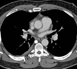 SVC Occlusion With Collaterals - CTisus CT Scan