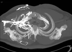 SVC Occlusion With Collaterals - CTisus CT Scan