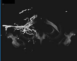 SVC Occlusion With Collaterals - CTisus CT Scan