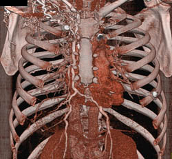 SVC Occlusion With Collaterals - CTisus CT Scan