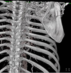 SVC Occlusion With Collaterals - CTisus CT Scan