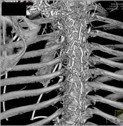 SVC Occlusion With Collaterals - CTisus CT Scan