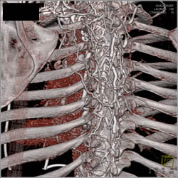 SVC Occlusion With Collaterals - CTisus CT Scan