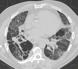 Interstitial Fibrosis Due to Sarcoidosis - CTisus CT Scan