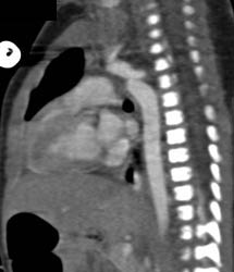 Coa of the Aorta - CTisus CT Scan