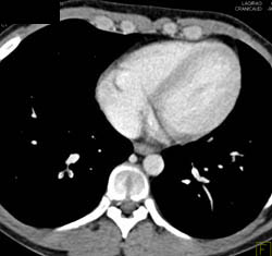 Pe - CTisus CT Scan