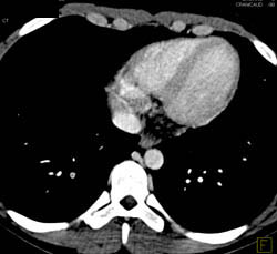 Pe - CTisus CT Scan