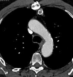 Thymoma - CTisus CT Scan