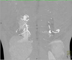 Pulmonary Arteriovenous Malformations (AVMs) in Multiple Sequences - CTisus CT Scan