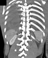 Loculated Fluid - CTisus CT Scan