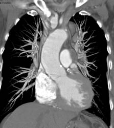 Thymoma - CTisus CT Scan