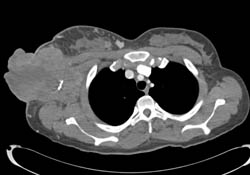 Breast Cancer With Multiple Nodes in Breast and Ulcerating Axillary Mass - CTisus CT Scan