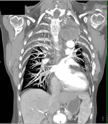 Thrombosed Subclavian Aneurysm - CTisus CT Scan