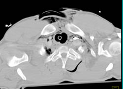 Pneumomediastinum - CTisus CT Scan