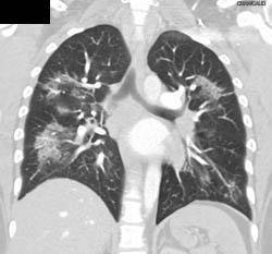 Pulmonary Infiltrates in Sarcoidosis - CTisus CT Scan