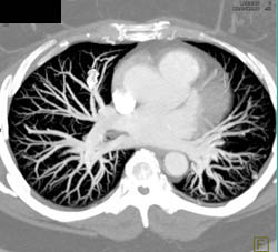 Pulmonary Arteriovenous Malformations (PAVMs) With Embolization - CTisus CT Scan