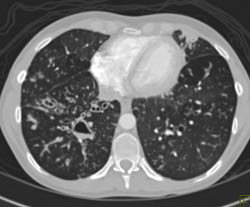 Cystic Fibrosis With Dilated Bronchial Arteries - CTisus CT Scan