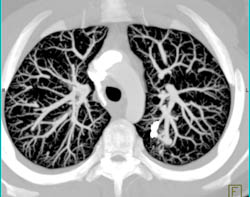 MIP for Pulmonary Arteriovenous Malformation (PAVM) Detection - CTisus CT Scan