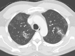 Patchy Infiltrates - CTisus CT Scan