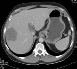 Liver Metastases and Lung Cancer Improves With Chemotherapy- See Sequence - CTisus CT Scan