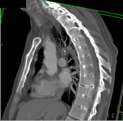 Ankylosing Spondylitis - CTisus CT Scan