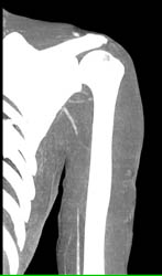 Branchial Artery Injury With Occlusion - CTisus CT Scan