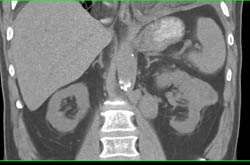 Renal Cancer With Lung Metastases - CTisus CT Scan