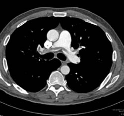 Massive Pe - CTisus CT Scan