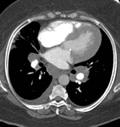 Pe - CTisus CT Scan