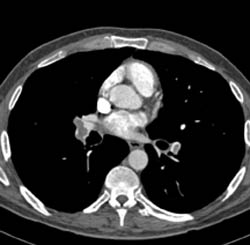 Pe - CTisus CT Scan