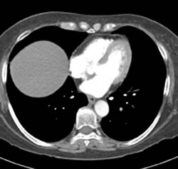 Pe - CTisus CT Scan