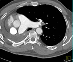 Pe - CTisus CT Scan