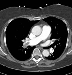 Pe - CTisus CT Scan