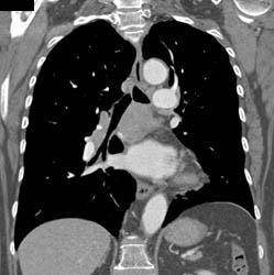 Subcarinal Nodes - CTisus CT Scan