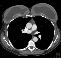 Breast Implants and Thymoma - CTisus CT Scan