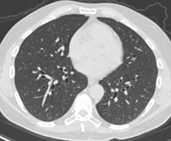 Patchy Nodule on Right Upper Lung - CTisus CT Scan