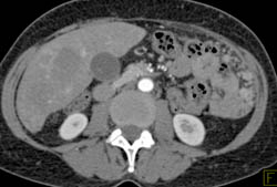 Metastatic Carcinoid With Implants on the Diaphragm - CTisus CT Scan