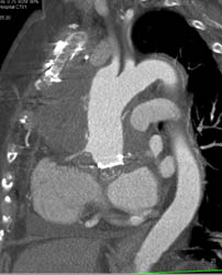 Repair of Aortic Root and Ascending Aorta With Post-op Changes - CTisus CT Scan