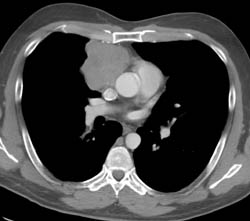 Thymoma - CTisus CT Scan