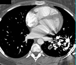 Embolization of Pulmonary Arteriovenous Malformation (PAVM) and of Pulmonary Artery - CTisus CT Scan