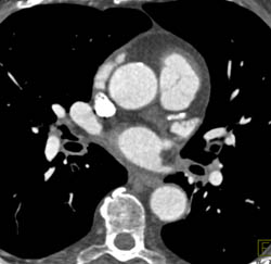 Clot in Left Atrium - CTisus CT Scan