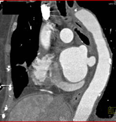 Clot in Right Atrium Due to Catheter- See Sequence - CTisus CT Scan