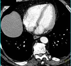 Pe - CTisus CT Scan