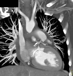 Normal Repair With Aortic Valve Replacement (AVR) and MVR in Multiple Perspectives - CTisus CT Scan