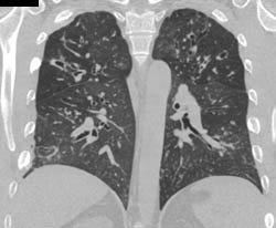 Bronchiectasis in Cystic Fibrosis - CTisus CT Scan