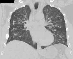 Bronchiectasis - CTisus CT Scan