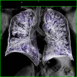 Bronchiectasis - CTisus CT Scan